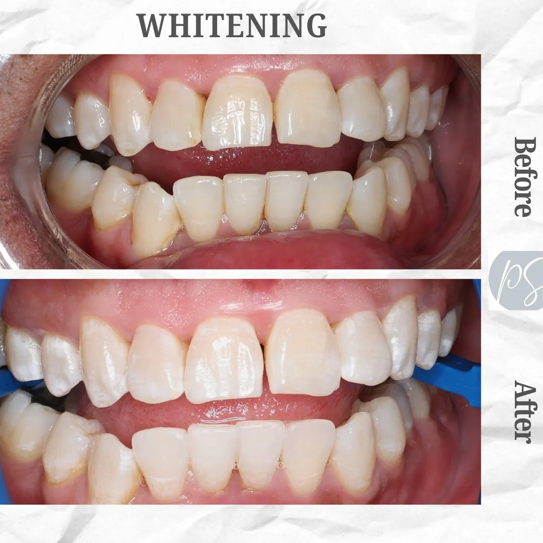 Blanqueamiento before and after