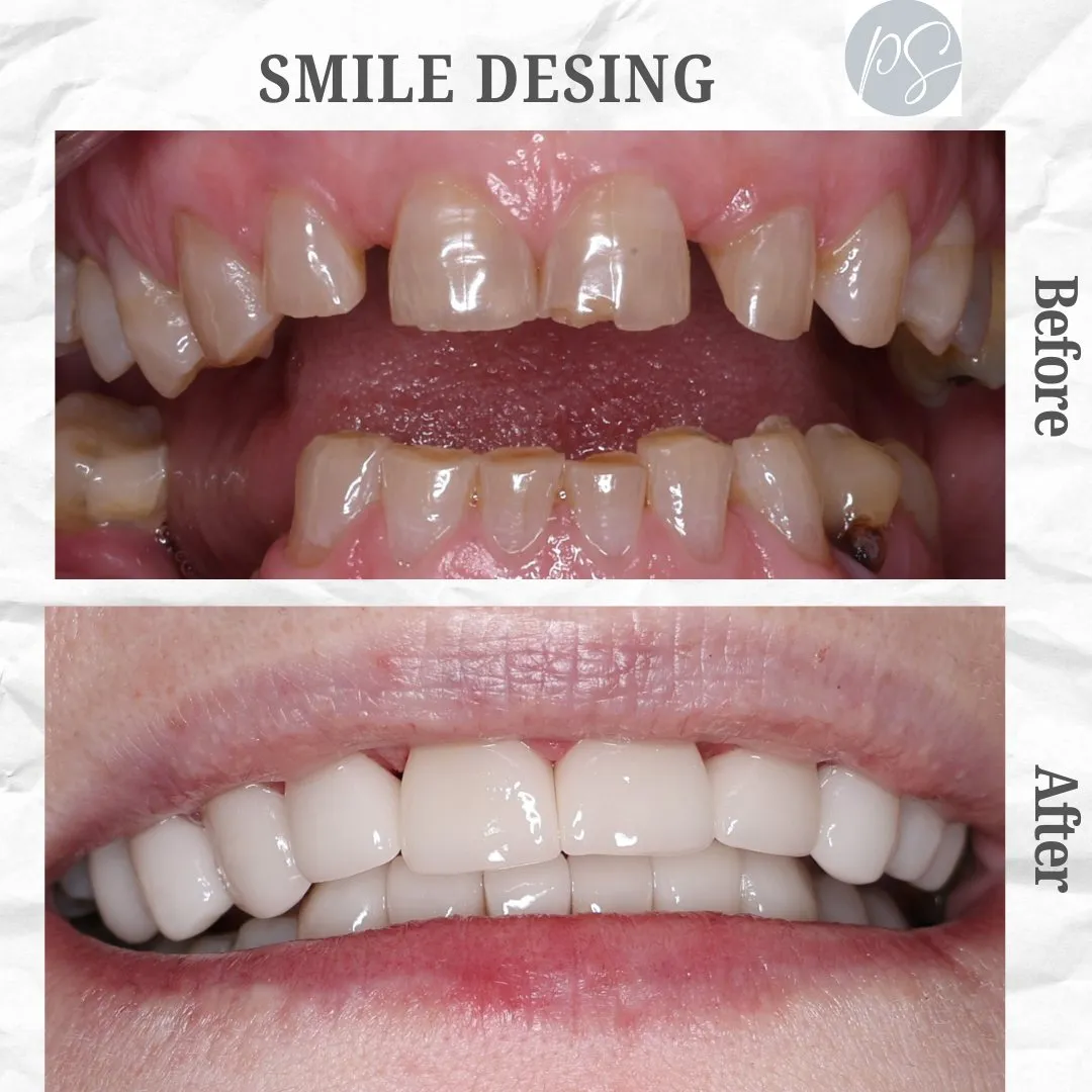Diseño de sonrisa before and after