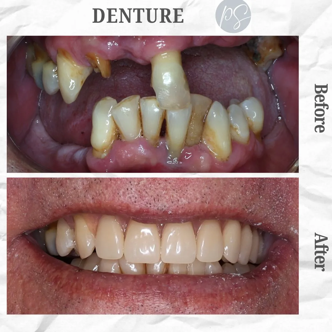 Prótesis before and after