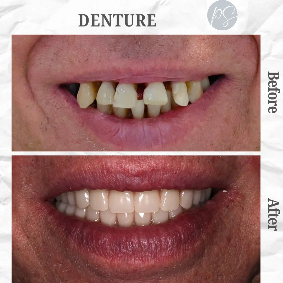 Prótesis before and after