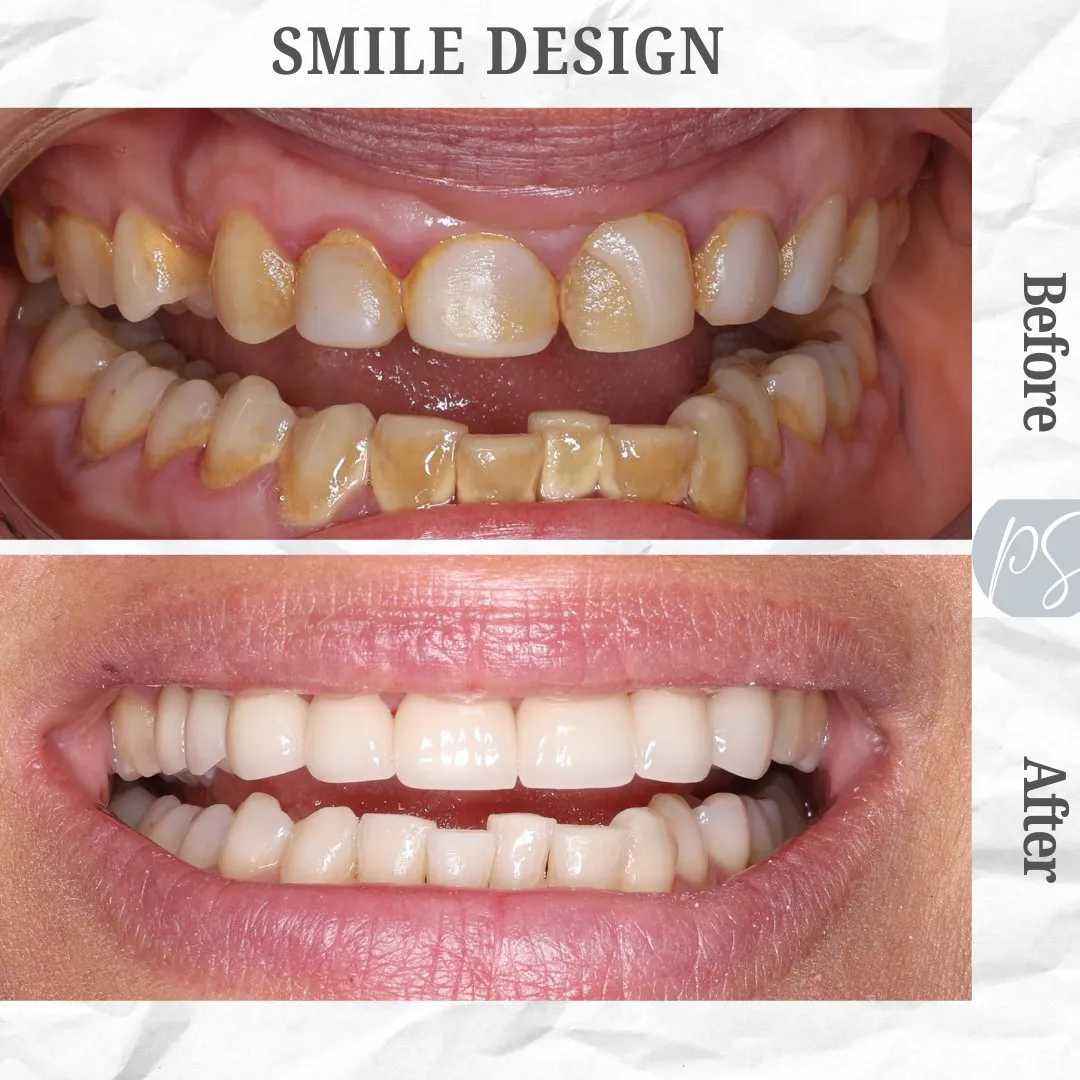 Diseño de sonrisa before and after