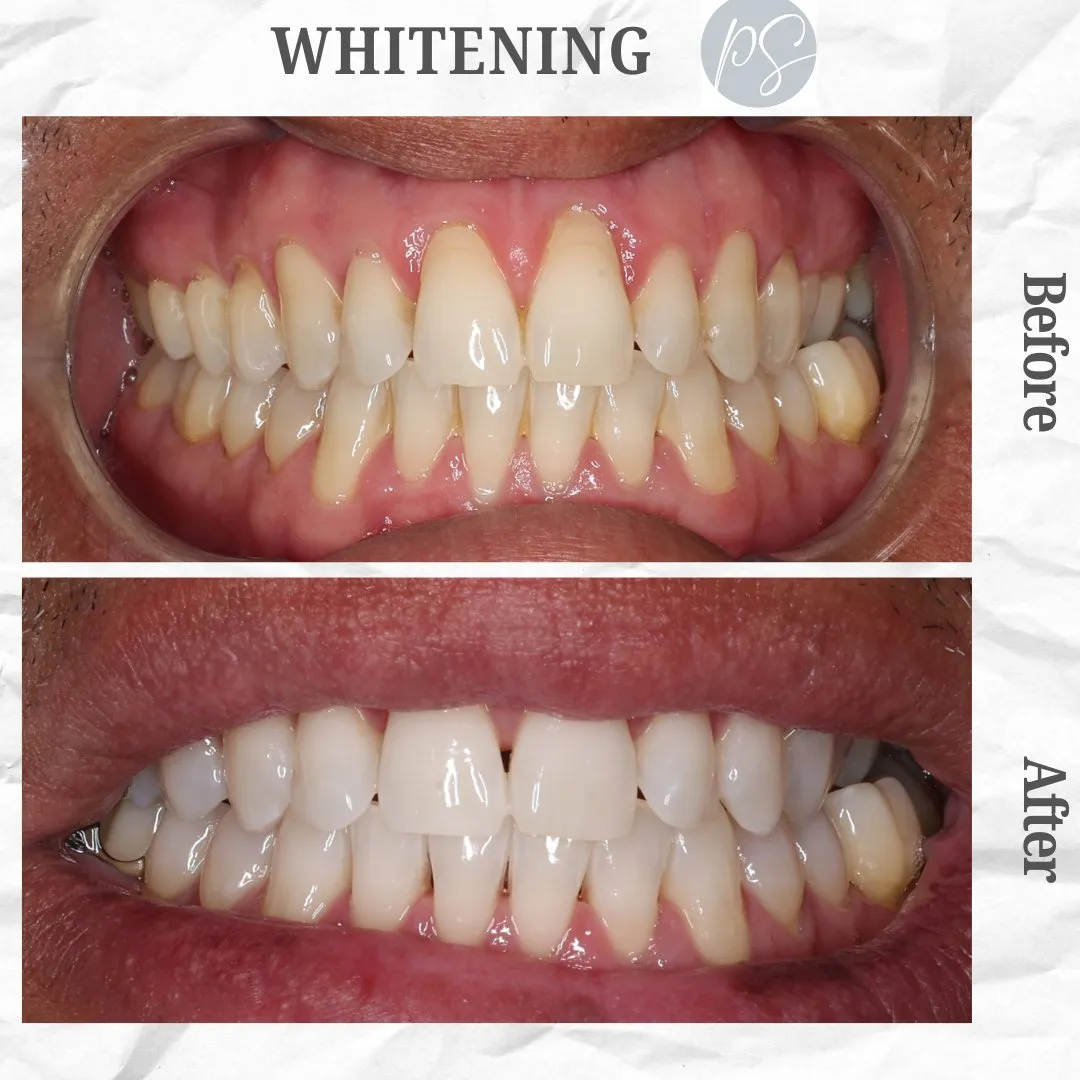 Blanqueamiento before and after